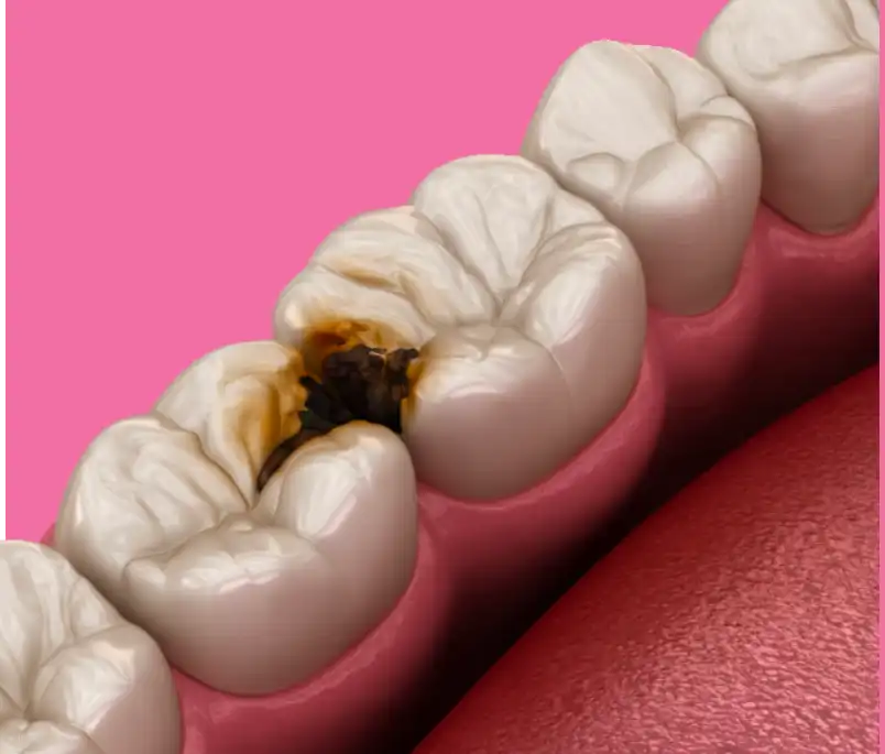 Denti cariati - Dentista Treviso e Biban Di Carbonera - conservativa e riparazione denti Denti cariati - Dentista Treviso e Biban Di Carbonera - conservativa e riparazione denti