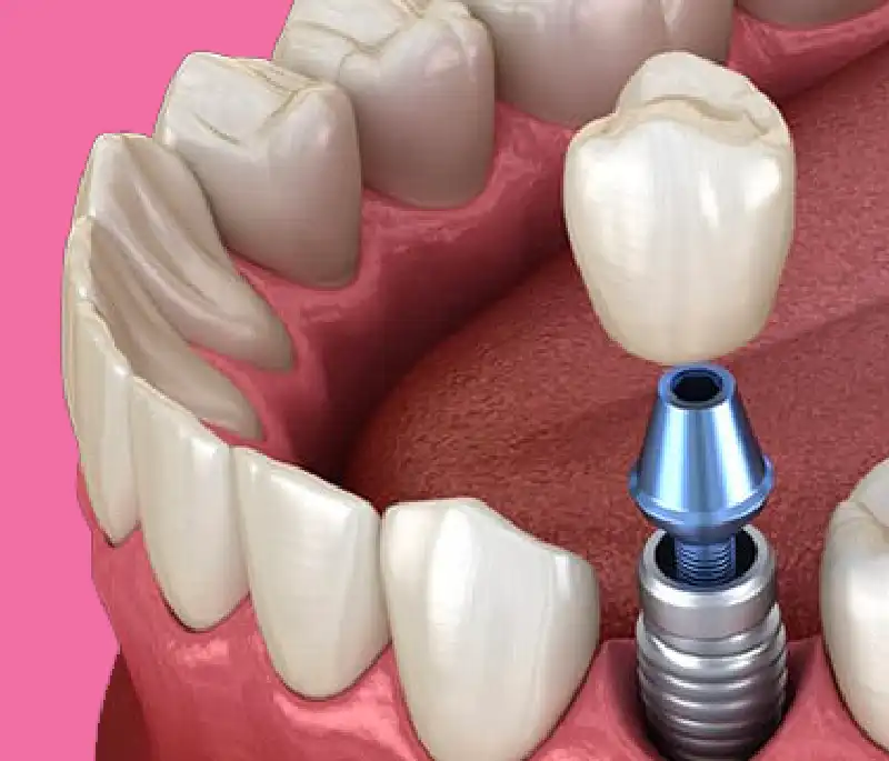 implantologia-denti-trattamenti-adriana-gestido-dentista-trattamento impianti dentali treviso biban di carbonera