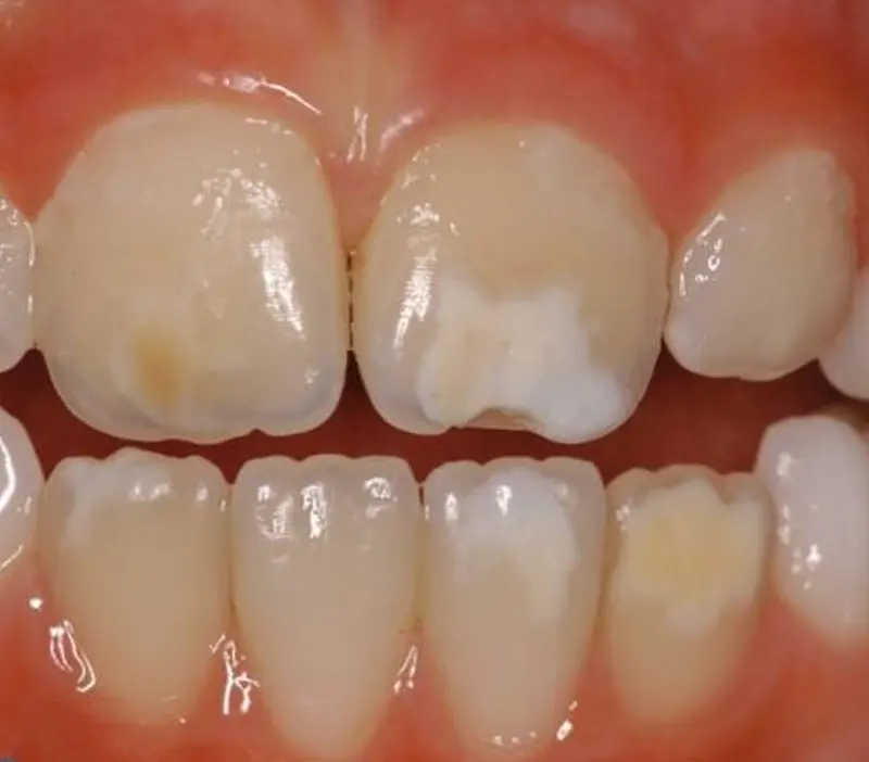 mih denti bambini carie ed mih