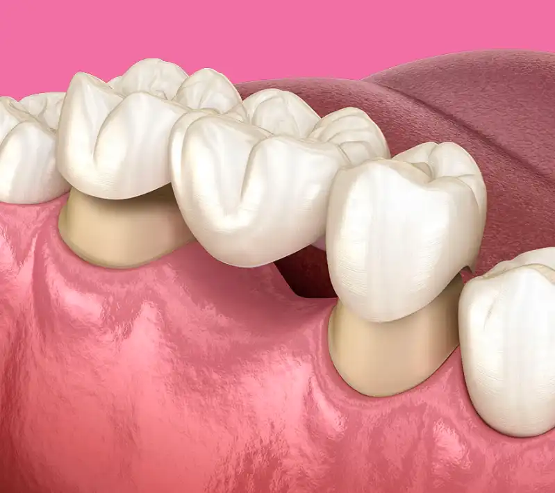 protesi-ponte-denti-trattamenti-adriana-gestido-dentista-trattamento protesi dentali